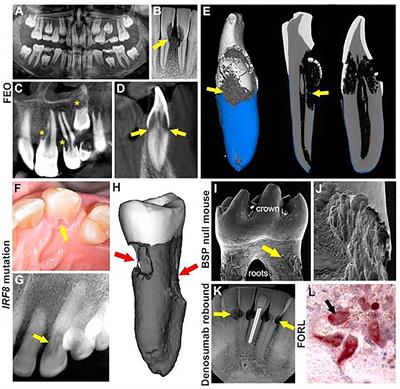 Multiple Idiopathic Cervical Root Resorption: A Challenge for a Transdisciplinary Medical-Dental Team